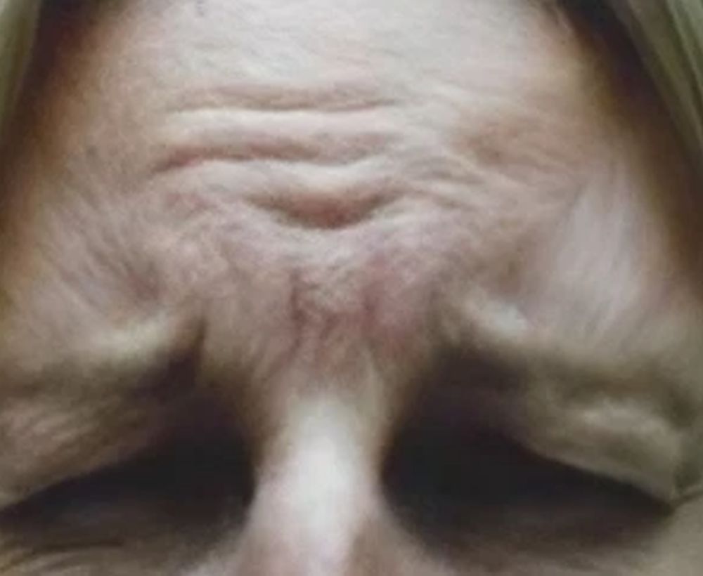 Wrinkle treatment - before image