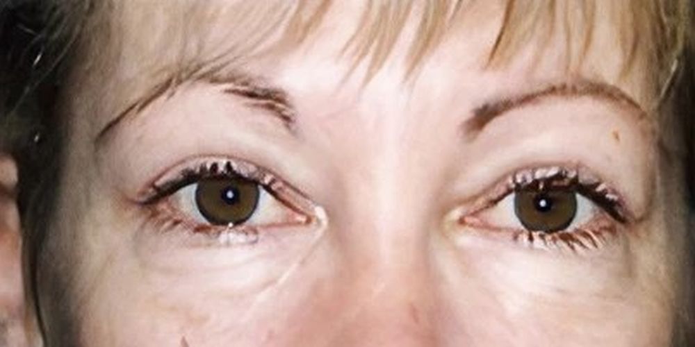 Blepharoplasty and eyelift procedure - after image