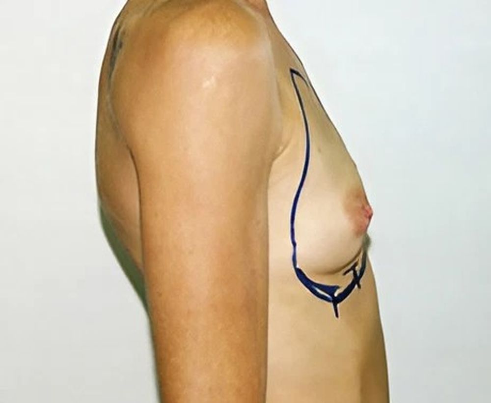 Breast augmentation and implant procedure - before image