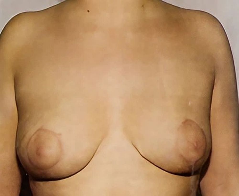 Breast reduction and lift procedure - after image