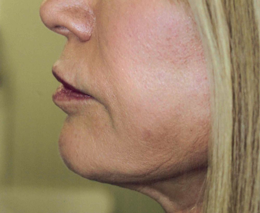 Face and neck lift procedure - after image