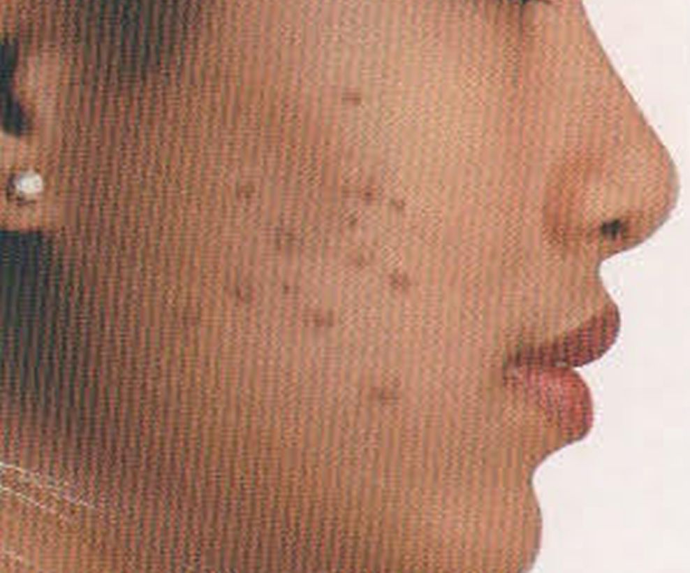 Keloid and other skin condition treatment - before image