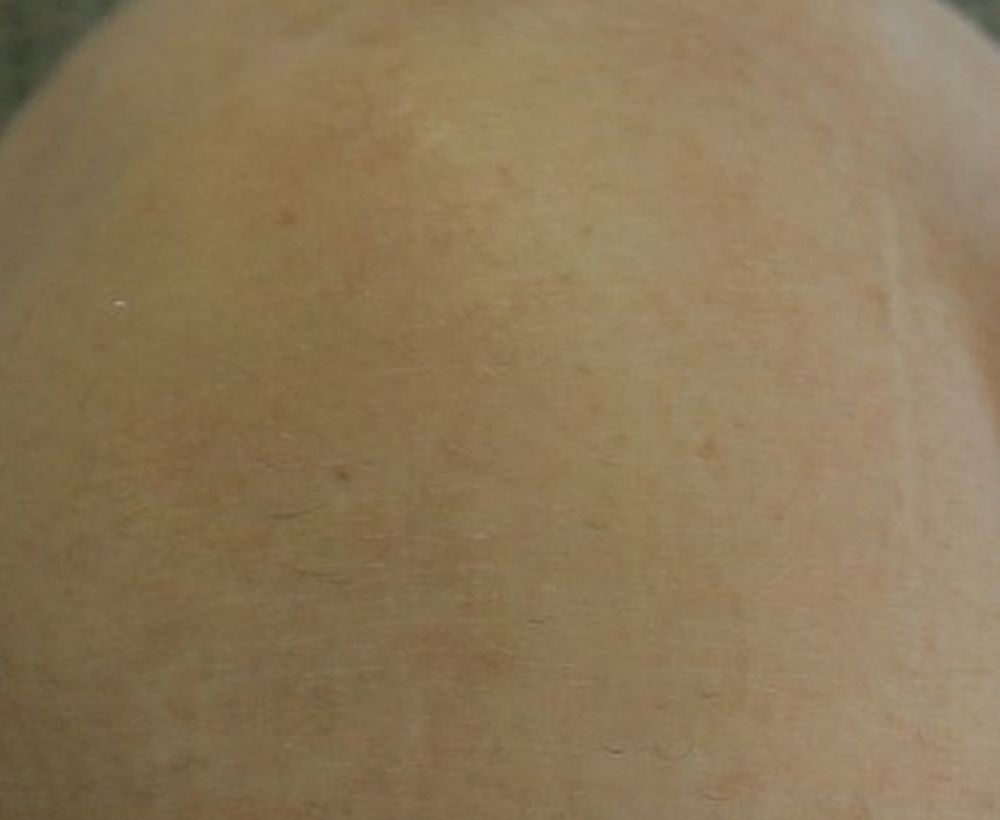 Keloid and other skin condition treatment - after image
