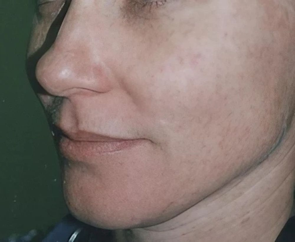 Laser skin rejuvenation treatment - after image