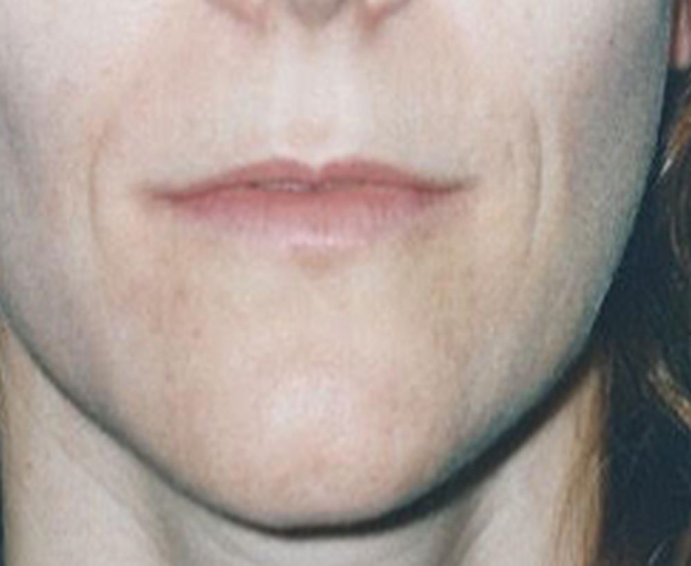 Wrinkle lip and filler treatment treatment - before image