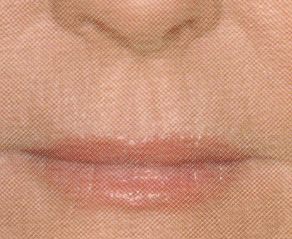 Wrinkle lip and filler treatment treatment - after image