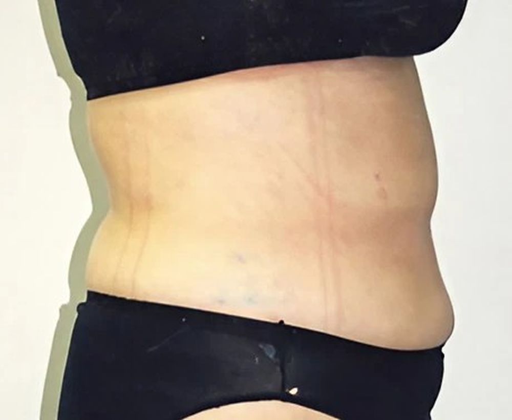 Liposuction and liposculpture procedure - after image