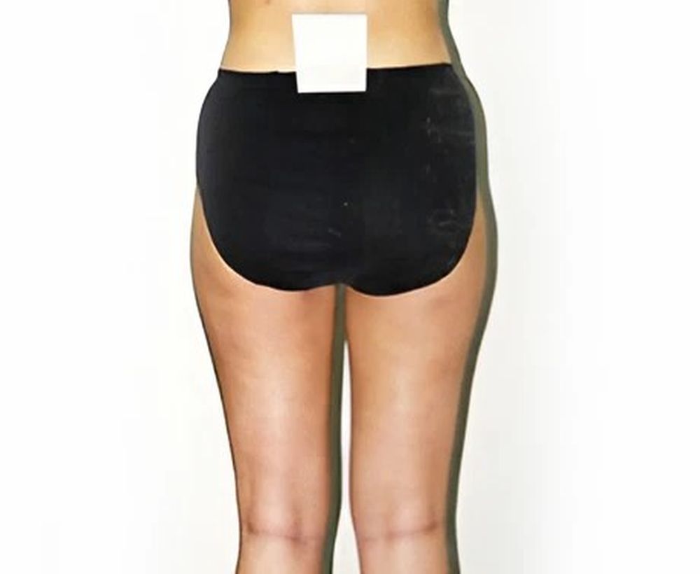 Liposuction and liposculpture procedure - after image
