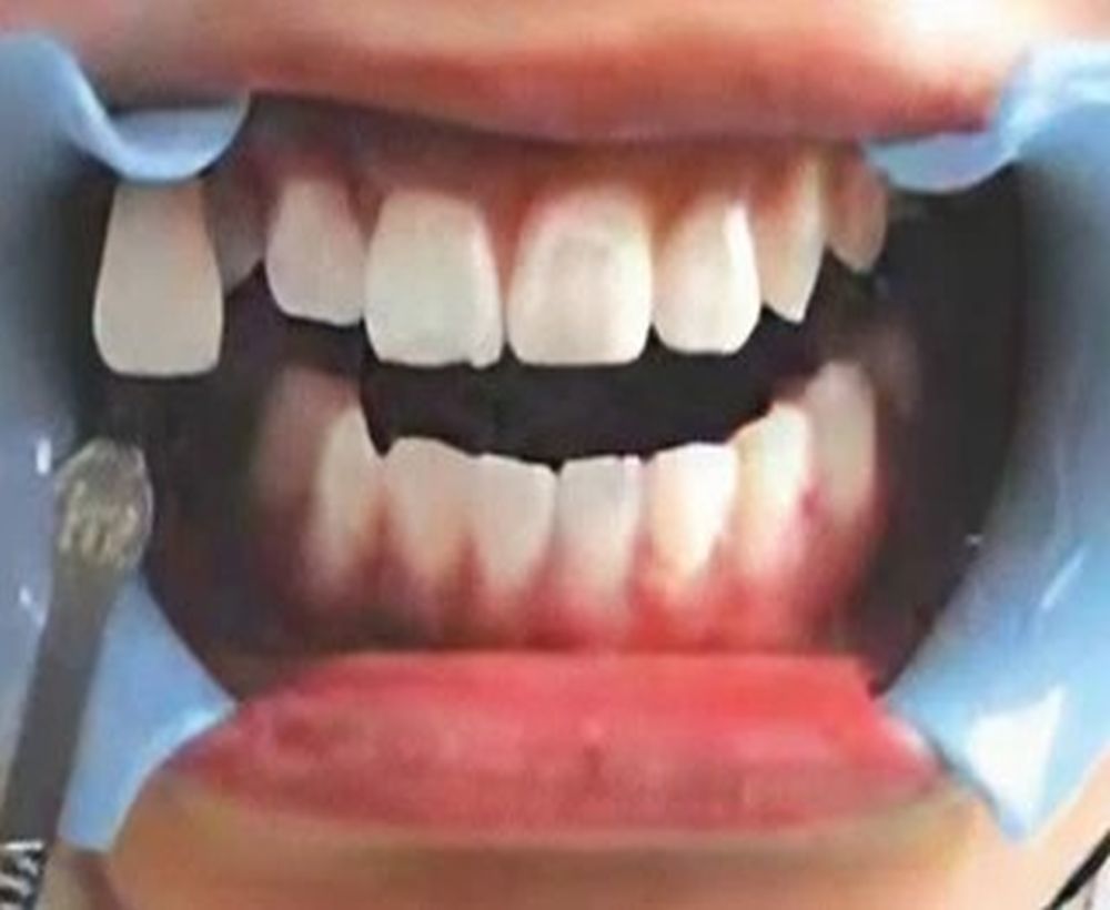 Cosmetic teeth whitening procedure - after image