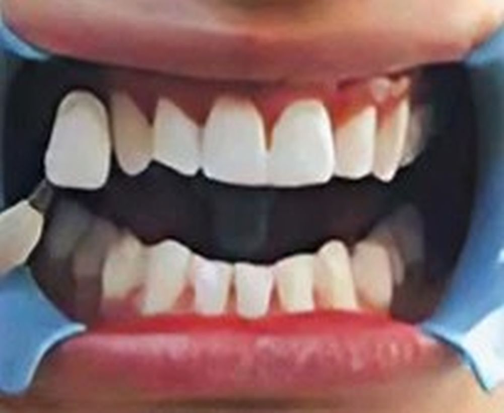 Cosmetic teeth whitening procedure - after image