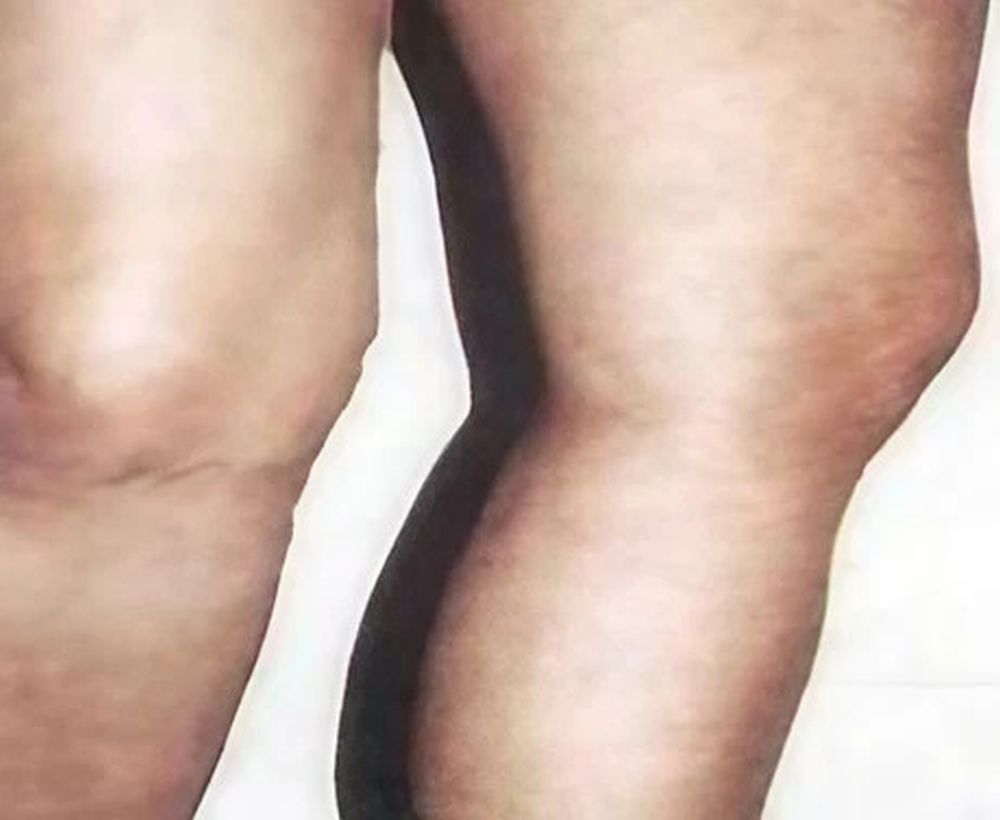Varicose and spider vein treatments - after image