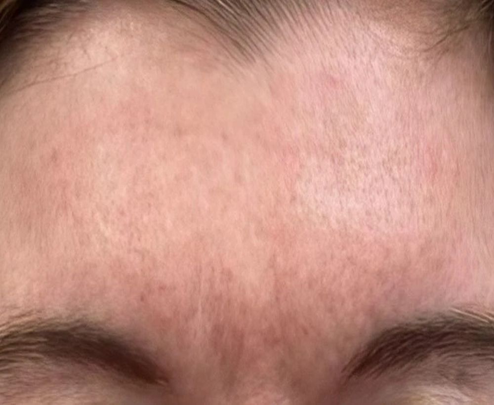 Wrinkle treatment - after image
