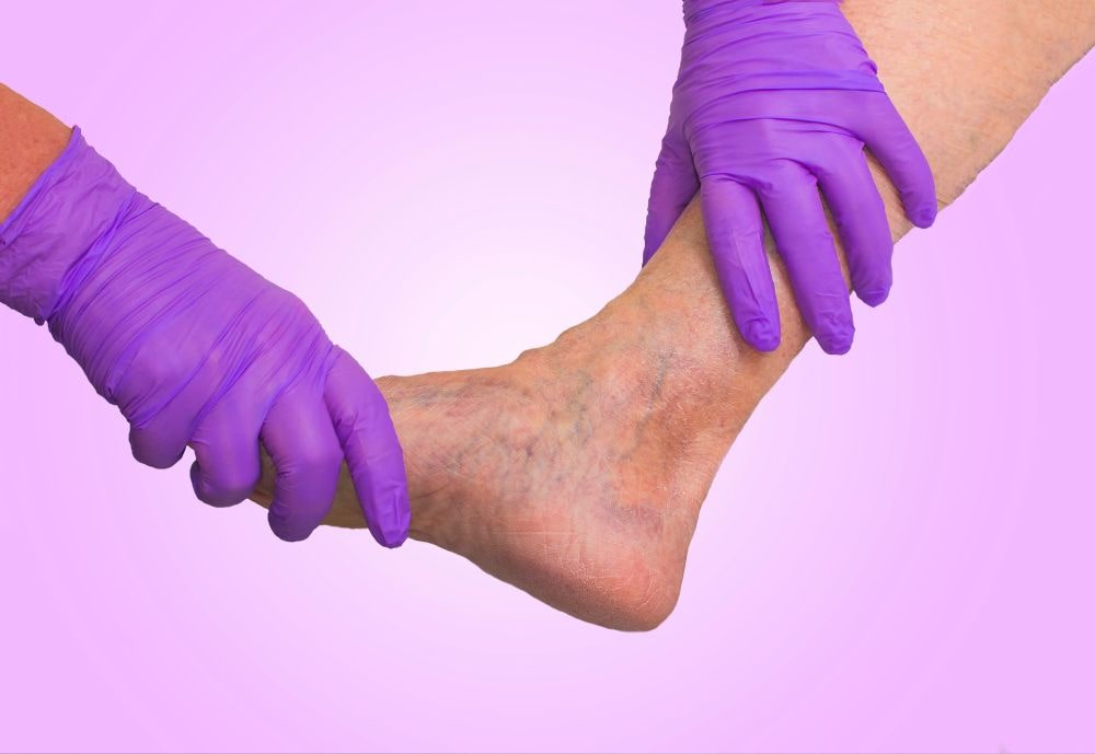 How To Treat Varicose Veins, From Treatments To Makeup