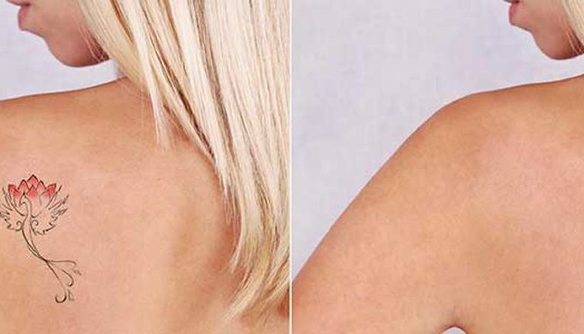 Celebs Who Have Had Tattoo Removal Blog Feature Image - Ashbury Cosmetics on Brisbane & the Gold Coast