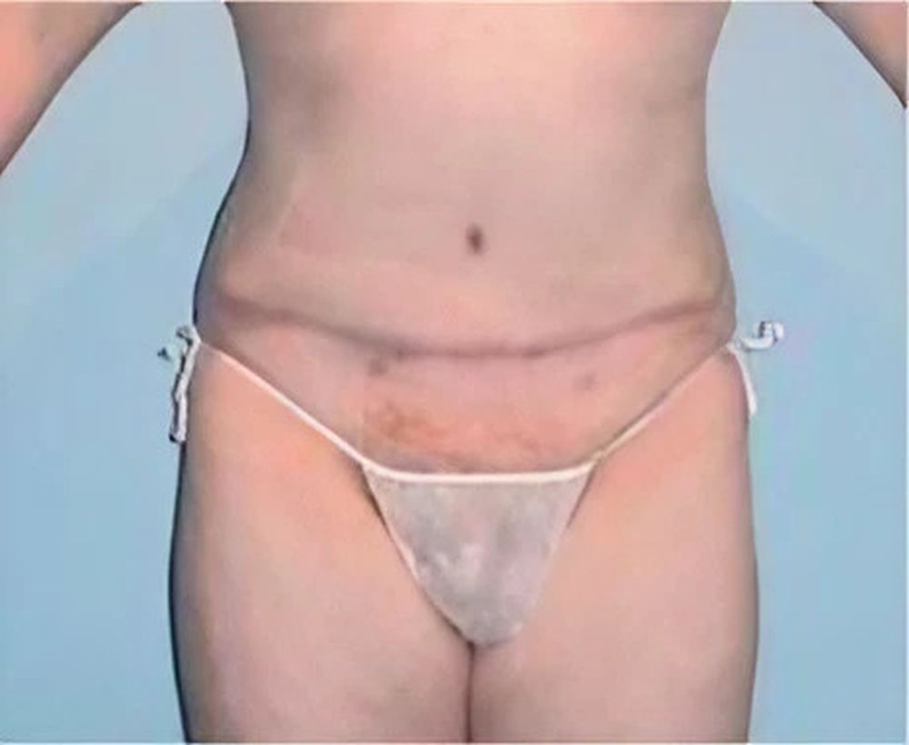 Abdominoplasty and tummy tuck procedure - after image