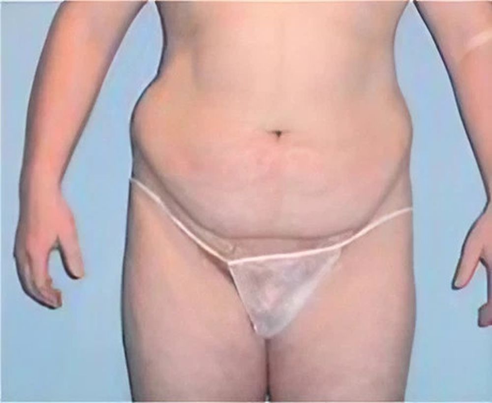 Abdominoplasty and tummy tuck procedure - before image