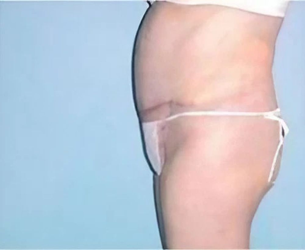 Abdominoplasty and tummy tuck procedure - after image