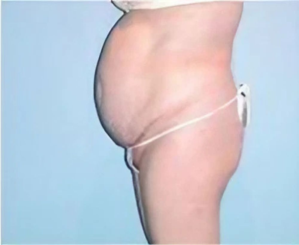 Abdominoplasty and tummy tuck procedure - before image