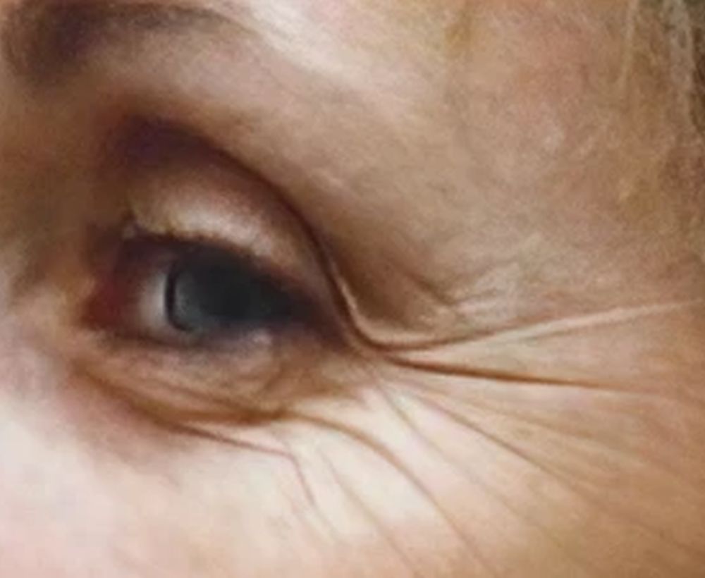 Anti-wrinkle treatment - before image