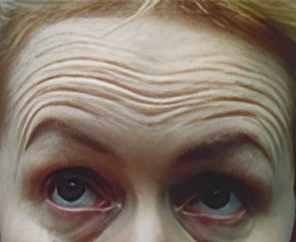 Anti-wrinkle treatment - before image