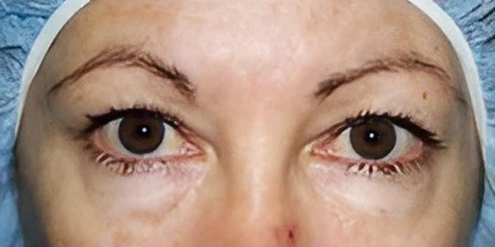 Blepharoplasty and eyelift procedure - before image