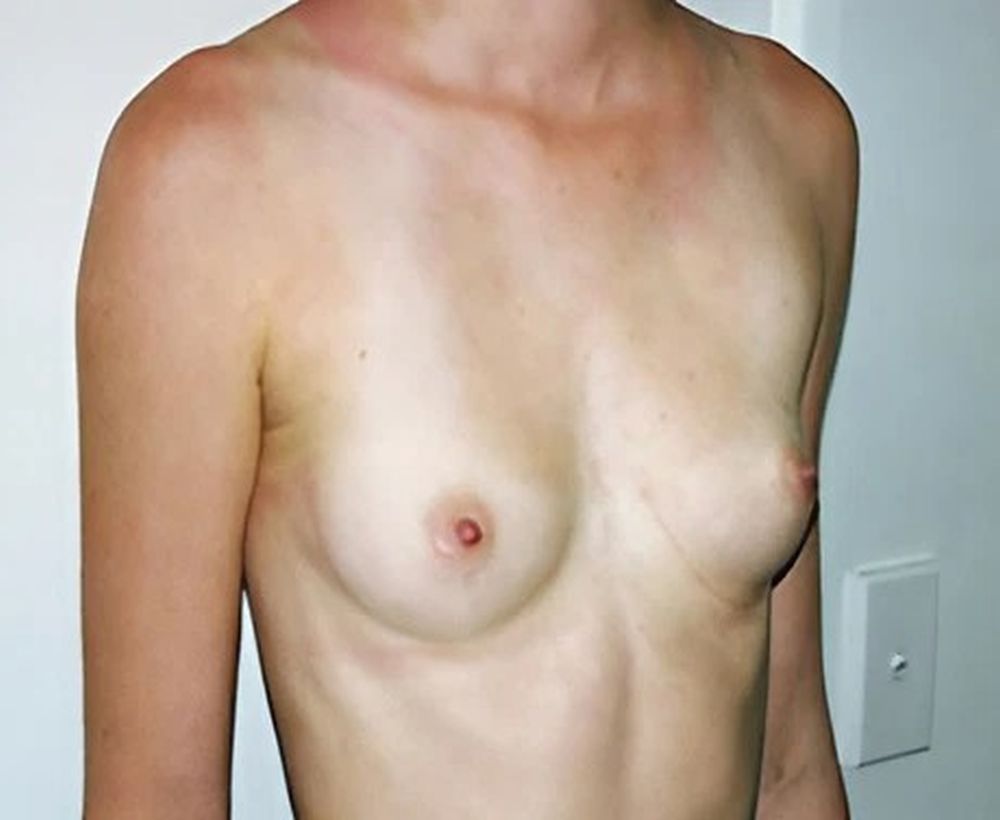 Breast augmentation and implant procedure - before image