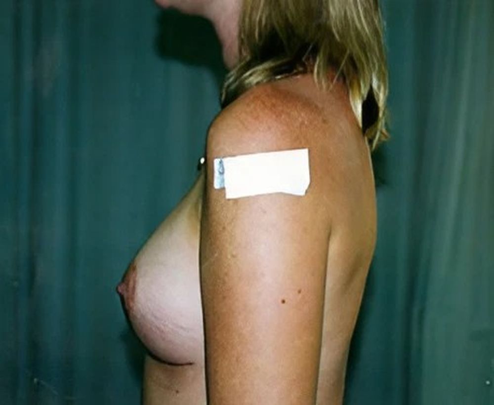 Breast augmentation and implant procedure - after image