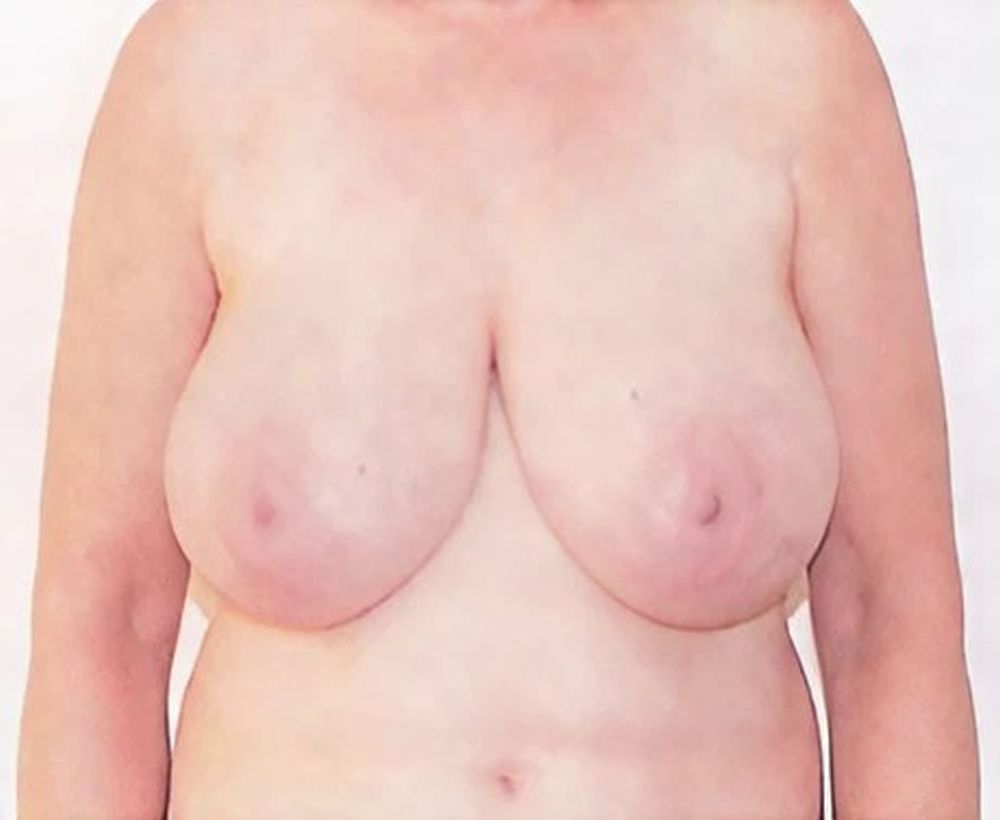 Breast reduction and lift procedure - before image