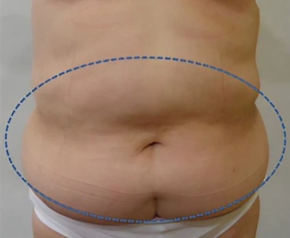 Cooltech fat freezing and cool shaping procedure - after image