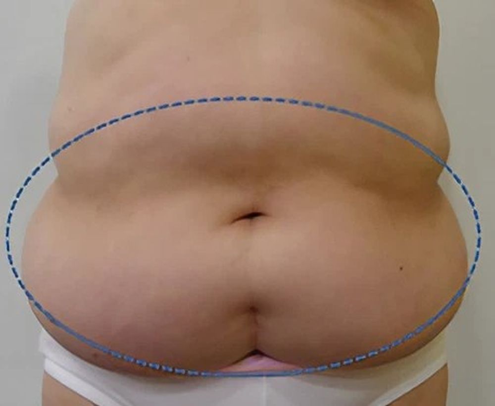Cooltech fat freezing and cool shaping procedure - before image