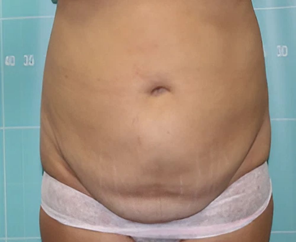 Cooltech fat freezing and cool shaping procedure - before image