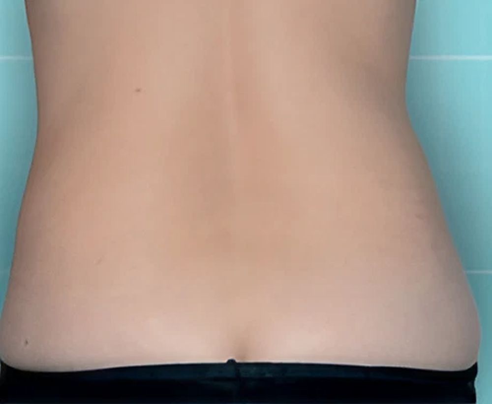 Cooltech fat freezing and cool shaping procedure - after image