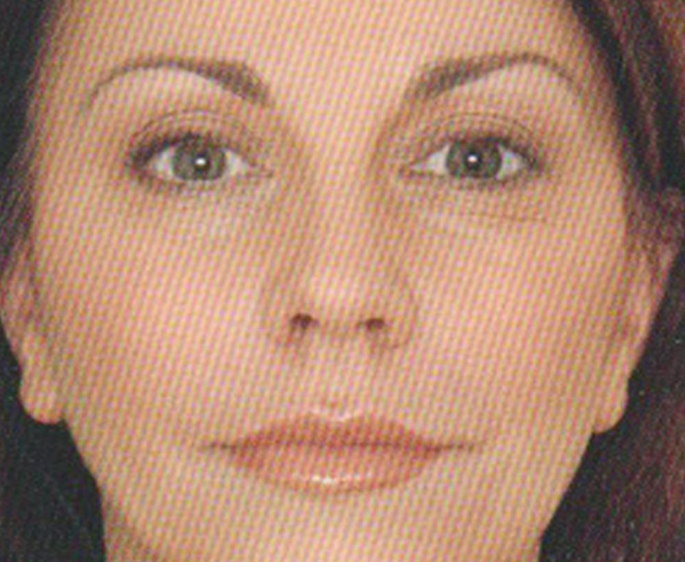 Anti-wrinkle lip and dermal filler treatment - after image