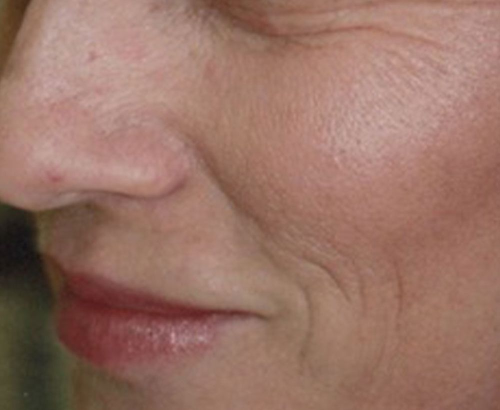 Anti-wrinkle lip and dermal filler treatment - before image
