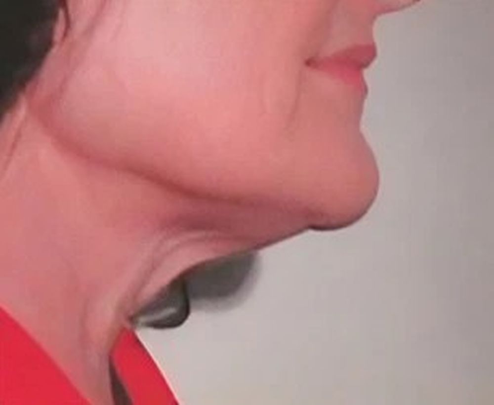 Face and neck lift procedure - before image