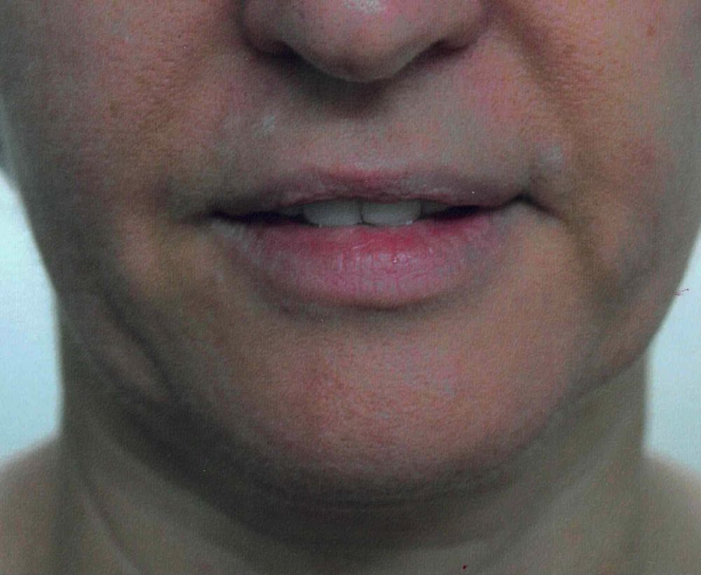 Face and neck lift procedure - before image
