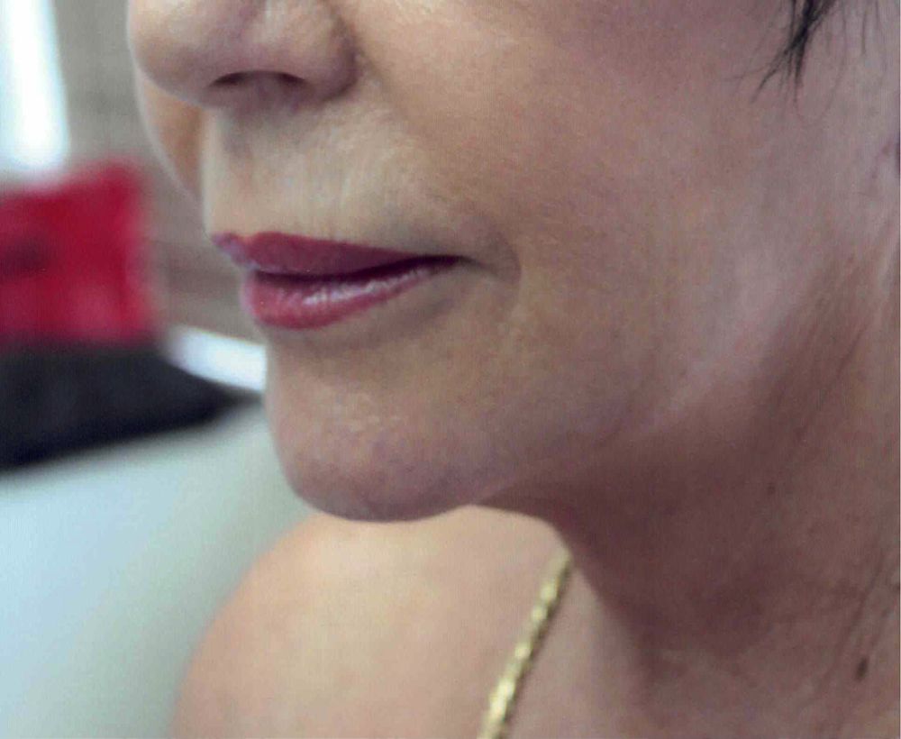 Face and neck lift procedure - after image