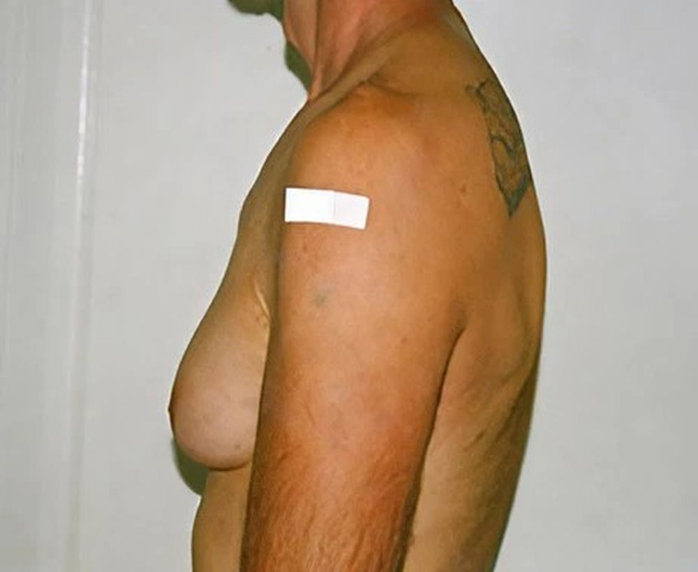 Male breast reduction procedure - before image