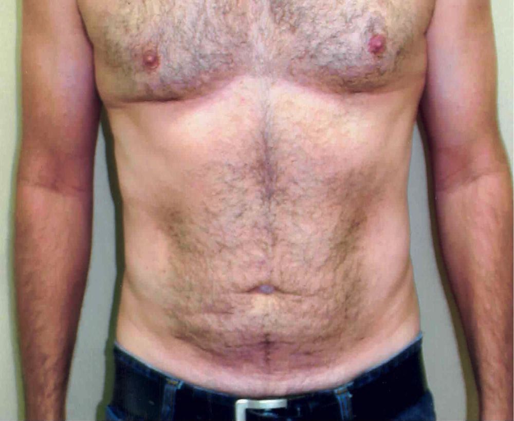 Male breast reduction procedure - after image