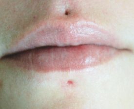 Before Before