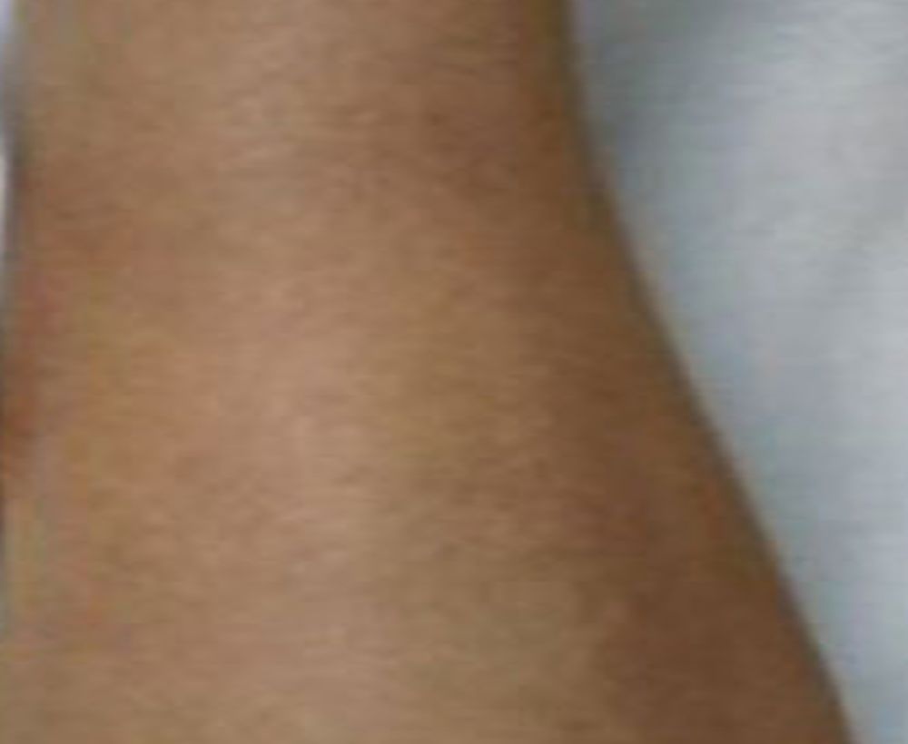Keloid and other skin condition treatment - after image