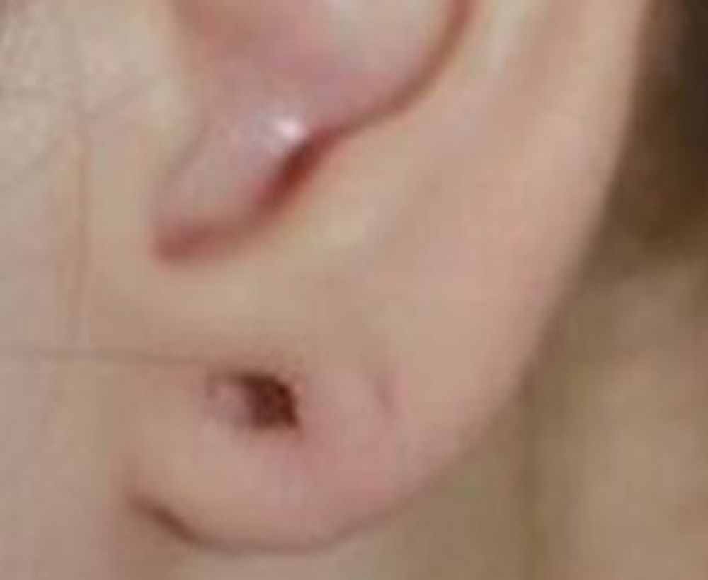 Keloid and other skin condition treatment - before image