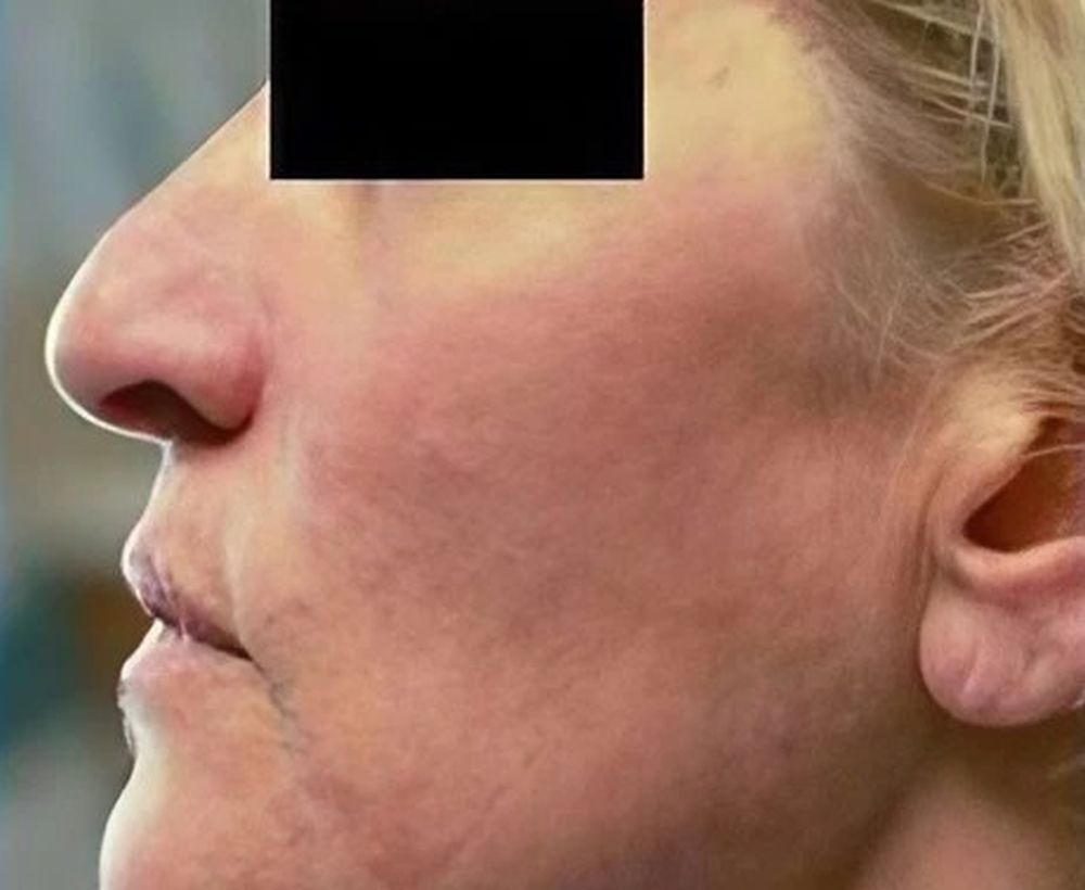 Laser skin rejuvenation treatment - after image