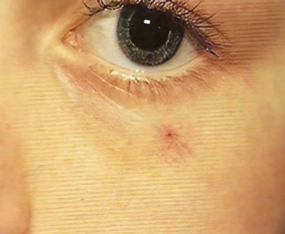 Laser skin rejuvenation treatment - before image