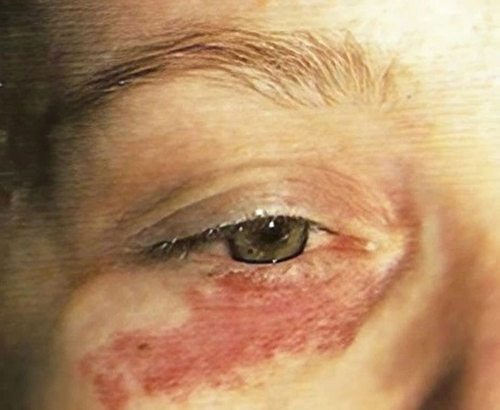 Laser skin rejuvenation treatment - before image