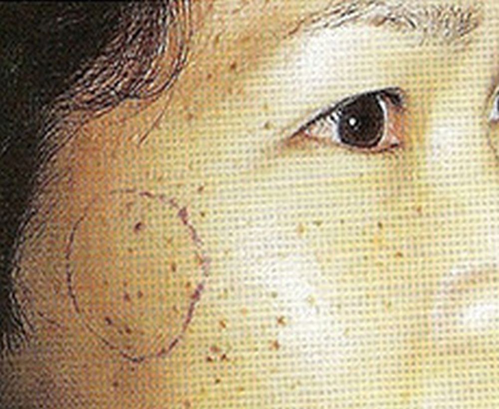 Laser mole removal procedure - before image