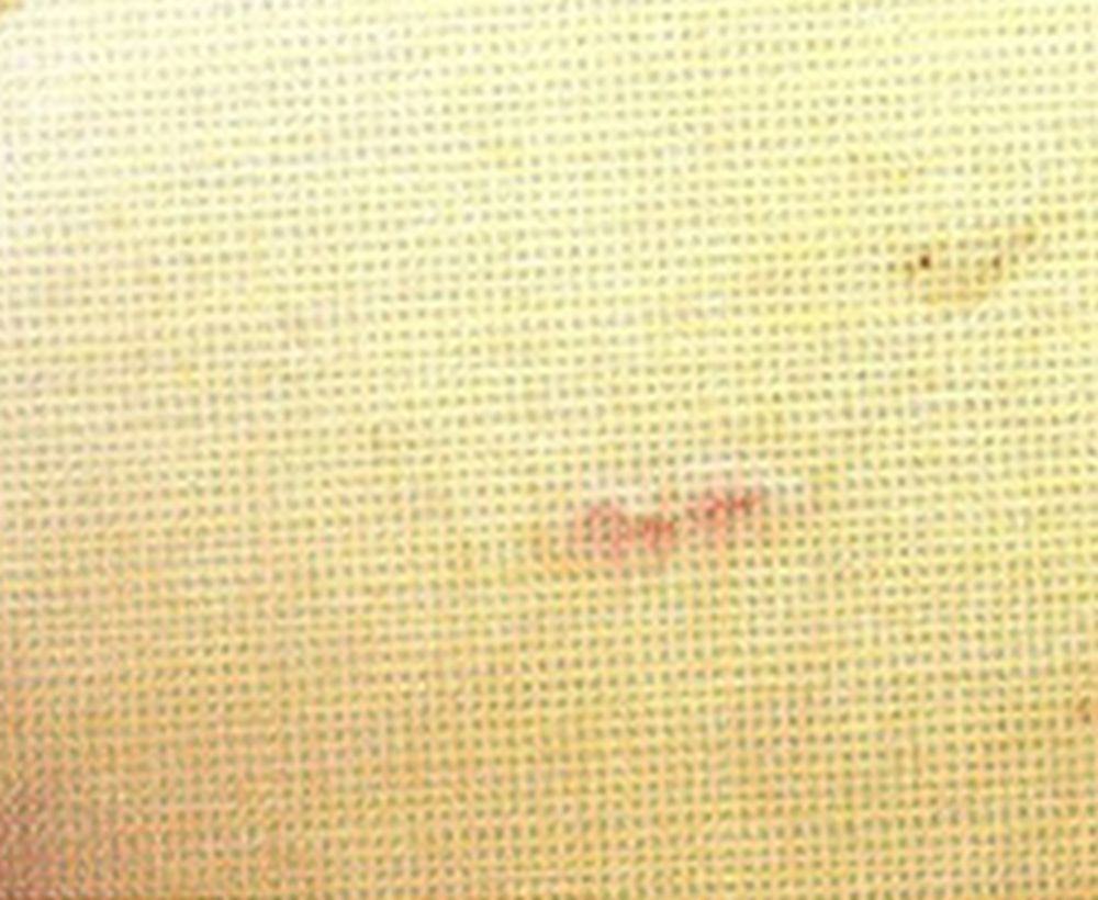 Laser mole removal procedure - after image