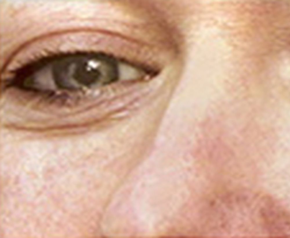 Laser skin resurfacing treatment - before image