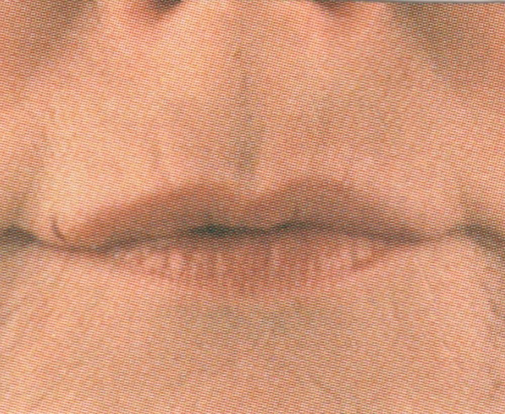 Anti-wrinkle lip and dermal filler treatment - after image