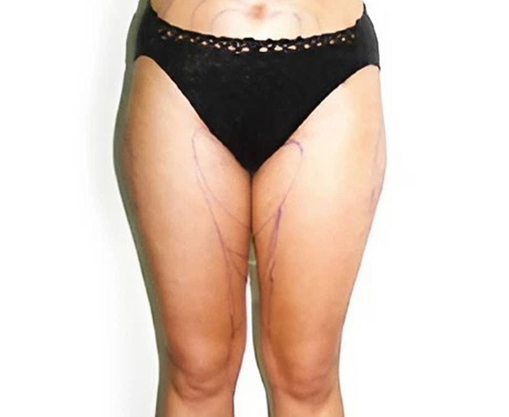 Liposuction and liposculpture procedure - before image